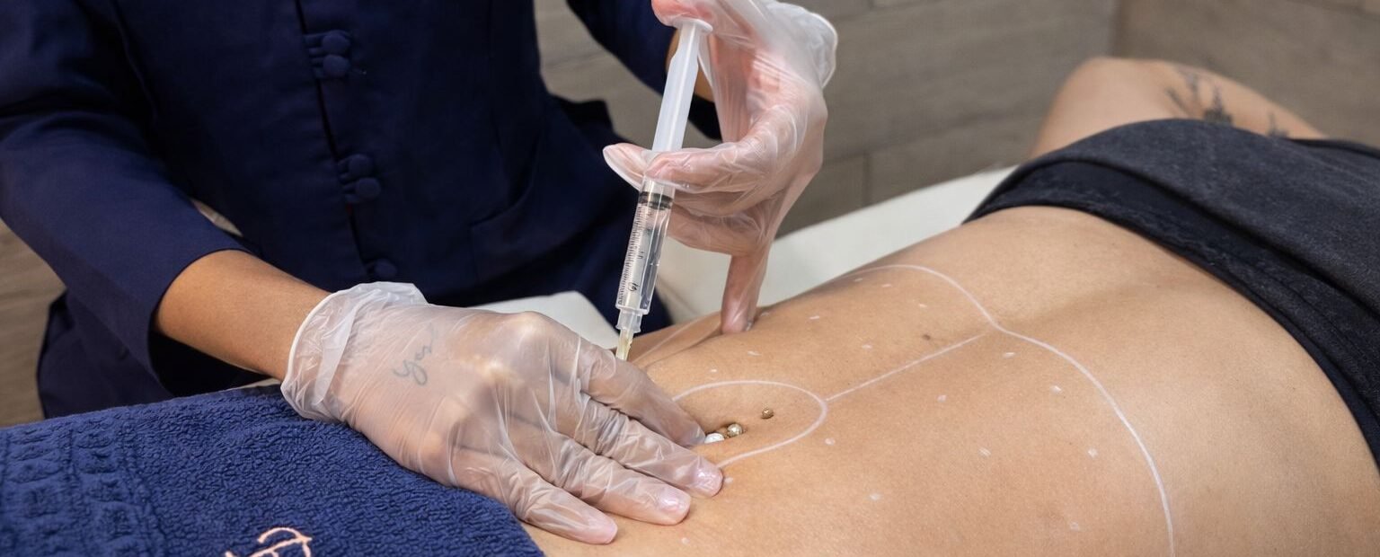 Intradermoterapia